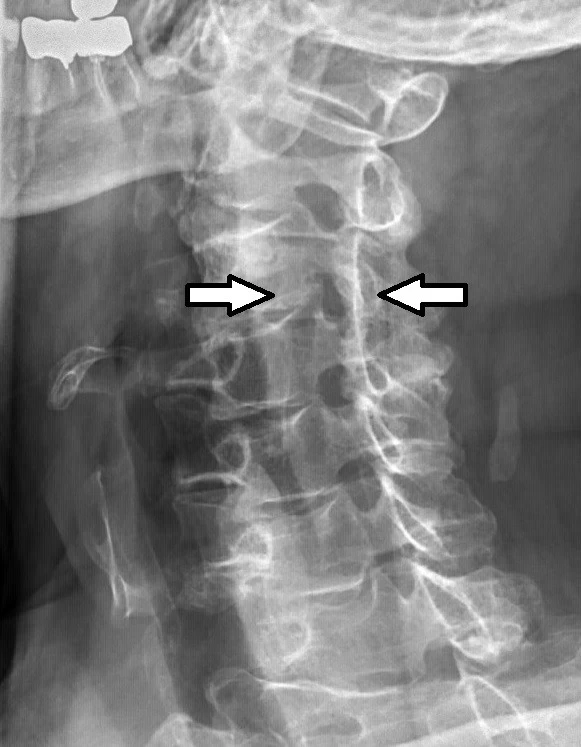 How Dangerous Is Spinal Stenosis?